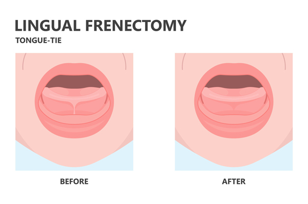 Comparison of a tongue-tie before and after a procedure.