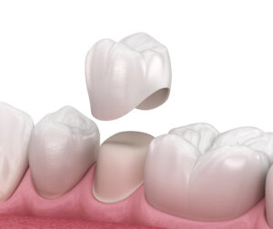 White Esthetic crowns in Pediatric dentistry