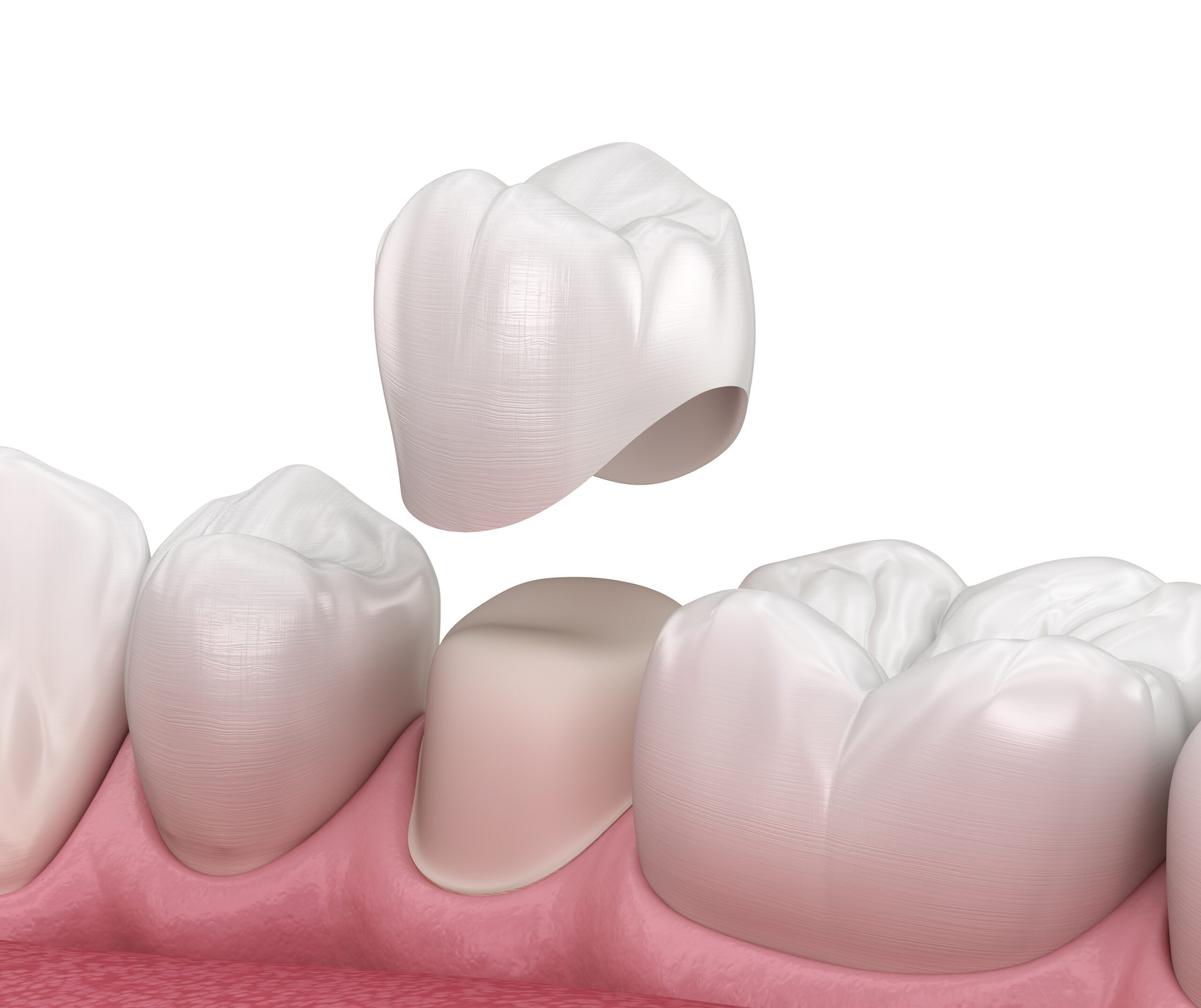 White Esthetic crowns in Pediatric dentistry